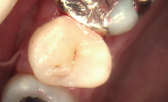 臼歯術後コンポジットレジン